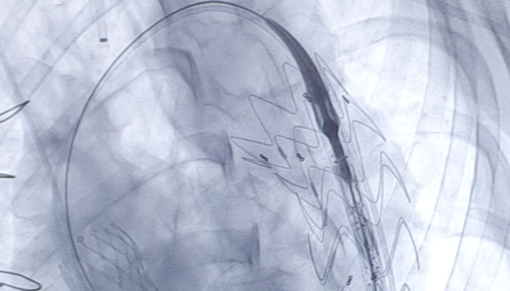Santaros klinikos: pirmą kartą Baltijos šalyse atlikta aortos lanko stentgrafto implantacija