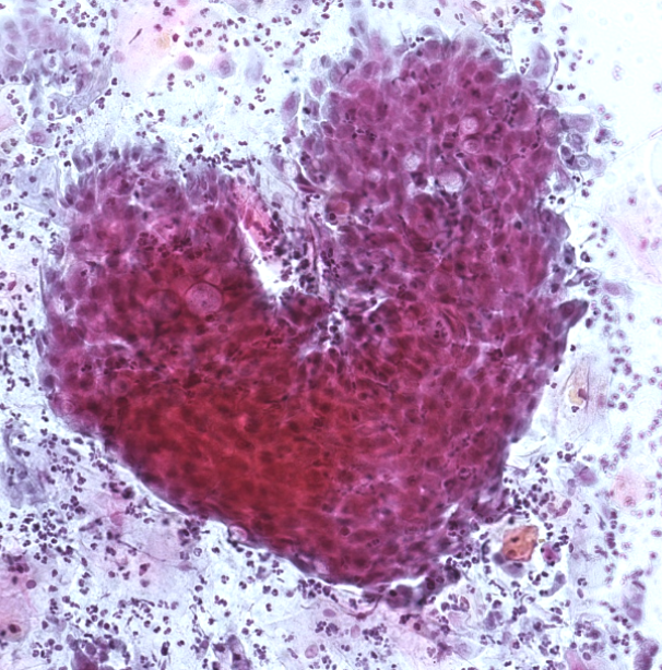 Gimdos kaklelio ląstelės matomos mikroskopu PAP testo metu išsidėsčiusios širdelės forma