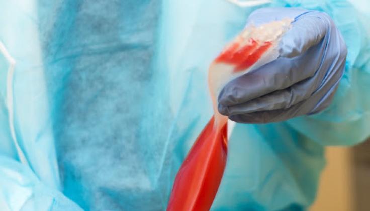 Naujas išsėtinės sklerozės gydymo būdas – kamieninių kraujodaros ląstelių transplantacija 