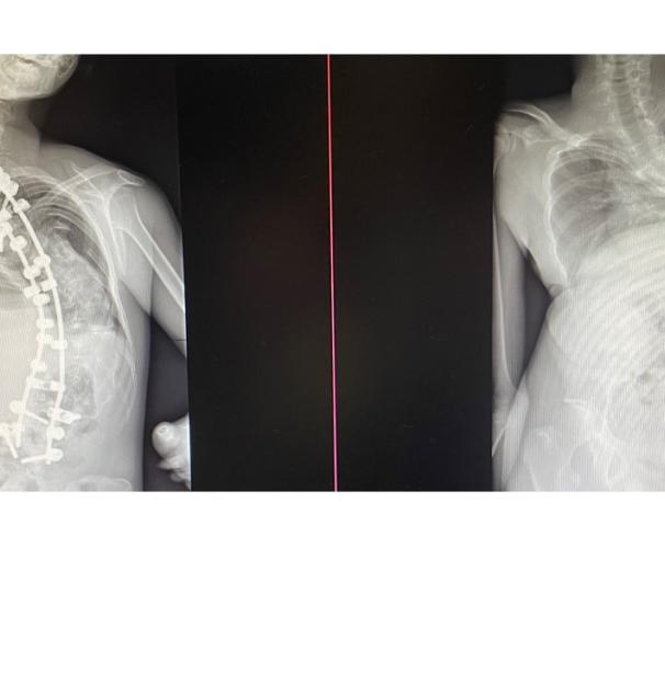 Rentgeno nuotraukos prieš ir po stuburo tiesinimo operacijos