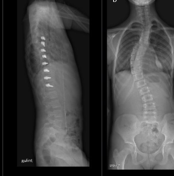 Stuburo operacijos rentgeno nuotrauka 