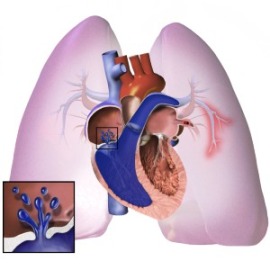 Pulmonary_Hypertension-e8c3b23ea6e7957764b00c78f8112877.jpg