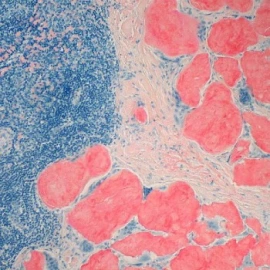 amyloidosis-fff14ef2e2ddb1dbc38220c7981442d2.jpg