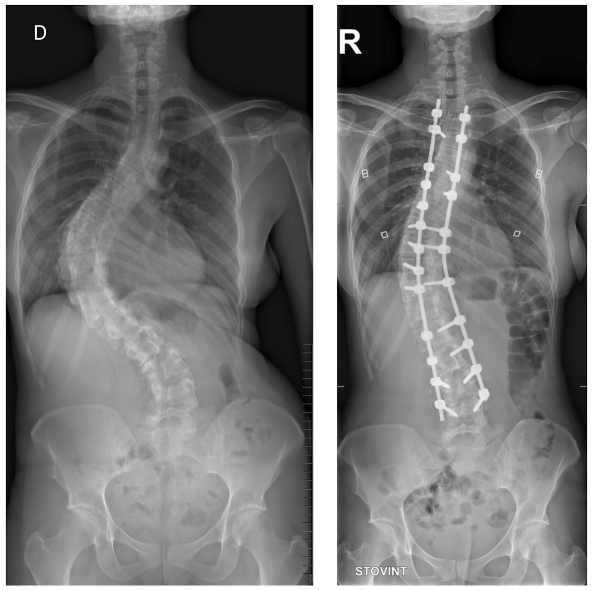 Suaugusiuju idiopatione skoliozė. Prieš operaciją (kairėje) - iškrypimo dydis apie 85 laipsniai (Cobb’o metodas), po operacijos (dešinėje) - apie 30 laipsnių.